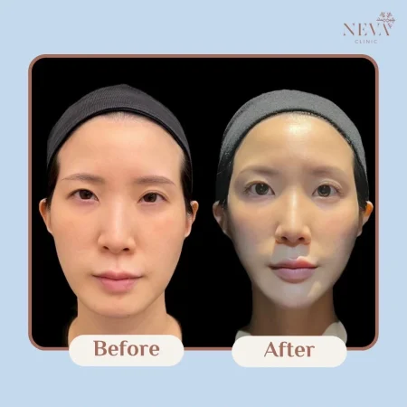 ภาพก่อน-หลังฉีด Filler ปรับโครงหน้าให้ดูสดใสและอิ่มฟูขึ้น