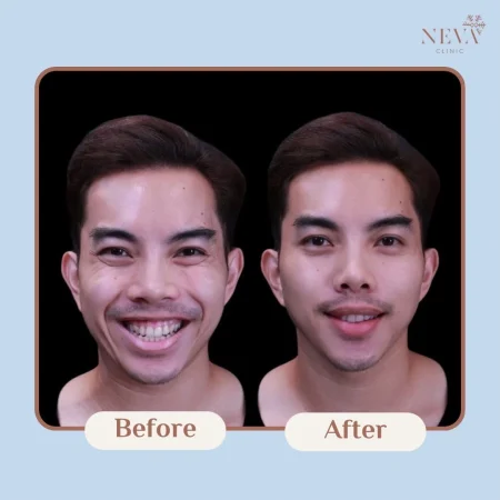 ภาพก่อน-หลังฉีด Filler ปรับรูปหน้าผู้ชายให้ดูกระชับและได้สัดส่วนขึ้น