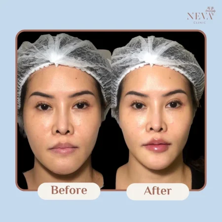 ภาพก่อน-หลังฉีด Filler ปรับรูปหน้าผู้ชายให้ดูคมชัดและกระชับขึ้น