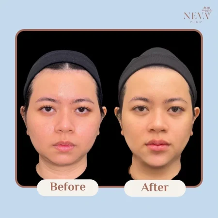 ภาพก่อน-หลังฉีด Filler ปาก เพิ่มความอิ่มฟูให้ริมฝีปากได้รูปสวยขึ้น