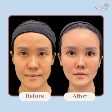 รีวิว-Filler-5