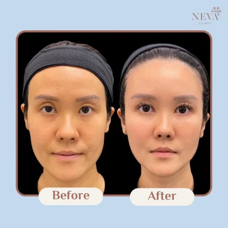 รีวิวก่อน-หลังฉีด Filler แก้ไขใต้ตาโหลและร่องแก้มให้ดูสดใสขึ้น