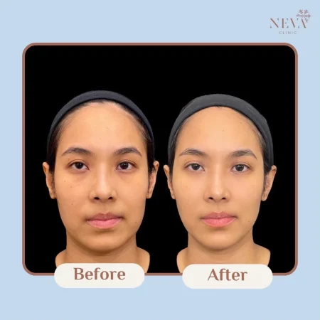 ภาพก่อน-หลังฉีด Filler ปรับรูปหน้าให้ดูเรียวและได้สัดส่วนมากขึ้น
