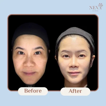 รีวิวก่อน-หลังการทำ Filler ผิวหน้าดูกระจ่างใสและเรียบเนียนขึ้นชัดเจน