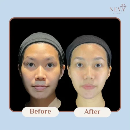 ภาพก่อน-หลังฉีด Filler ปรับรูปหน้าให้ผิวเรียบเนียนได้สัดส่วนขึ้น