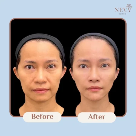 รีวิวก่อน-หลังฉีด Filler แก้ไขร่องแก้มลึกให้ดูอ่อนเยาว์ขึ้น